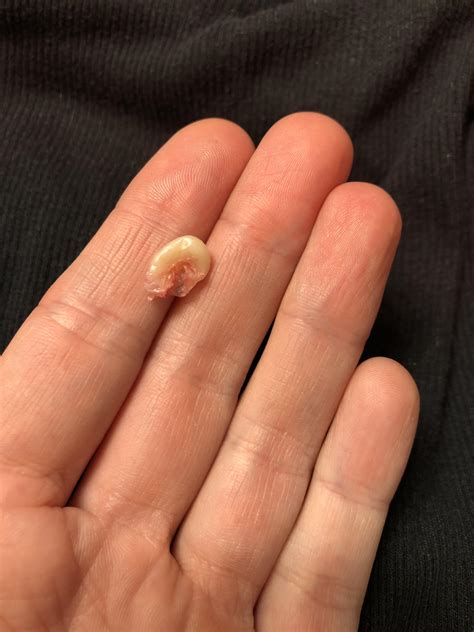 Popping a sebaceous cyst at home puts you at risk of developing an infection that could make you very unwell, or cause permanent damage to your skin. . Sebaceous cyst popping